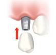 implant upper structure